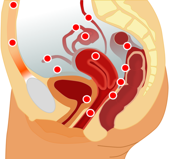 Localisations possibles de l'endométriose (Crédit photo : Female_anatomy.svg licensed with Cc-by-sa-3.0, GFDL)